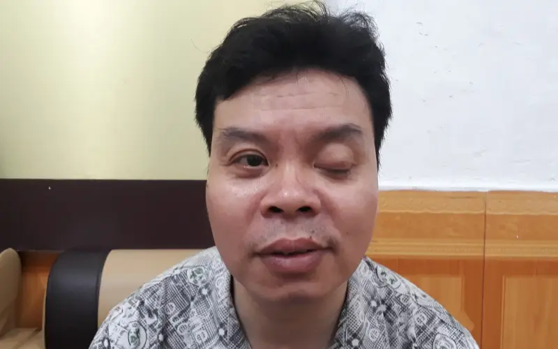 sụp mí mắt do liệt dây thần kinh 3 sau tai nạn