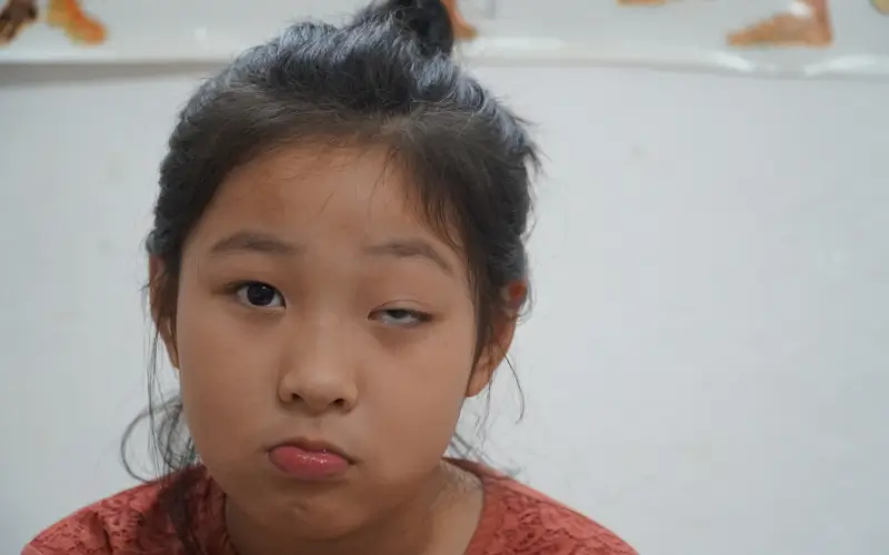 sụp mí mắt bẩm sinh