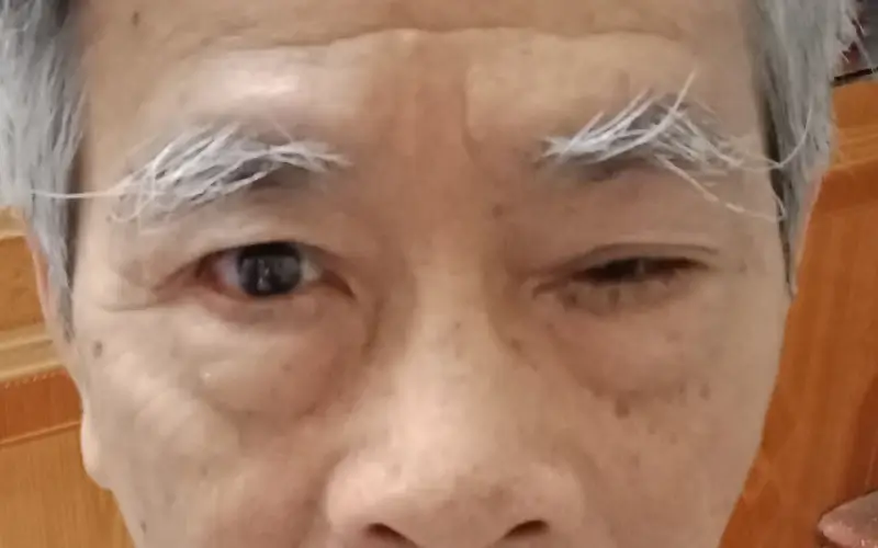 sụp mí mắt do thoái hóa melyn