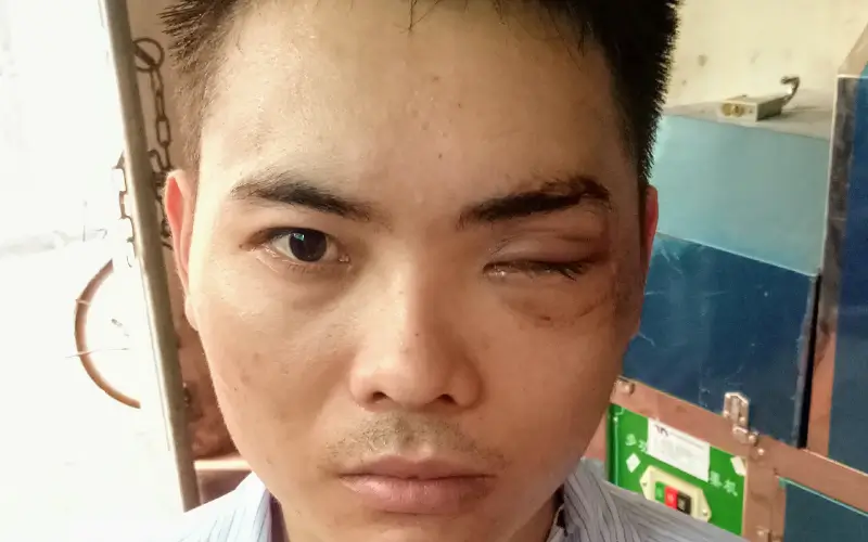 Sụp mi mắt sau tai nạn