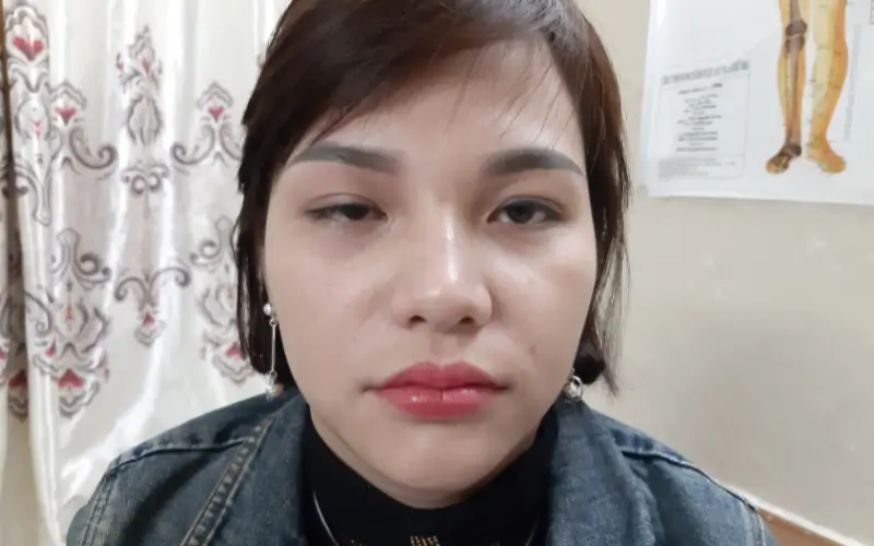 sụp mí mắt do biến chứng tiêm botox