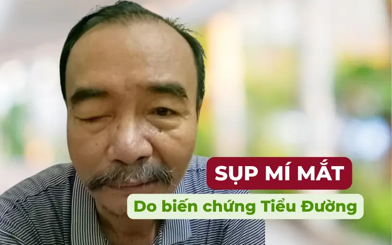 Sụp mí mắt do biến chứng tiểu đường