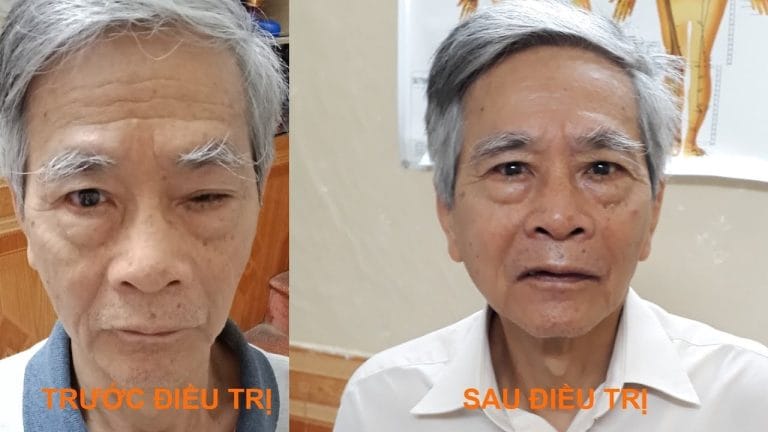 Chữa sụp mí mắt do lão hóa bằng Đông y