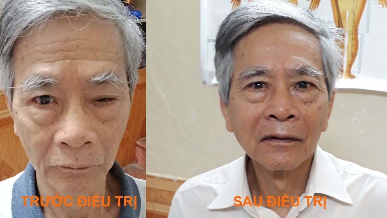 Chữa sụp mí mắt do lão hóa bằng Đông y