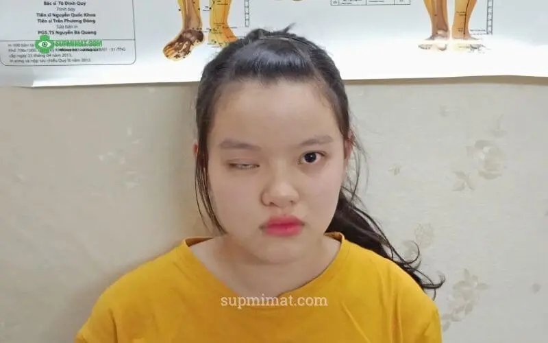 sụp mí mắt sau phẫu thuật