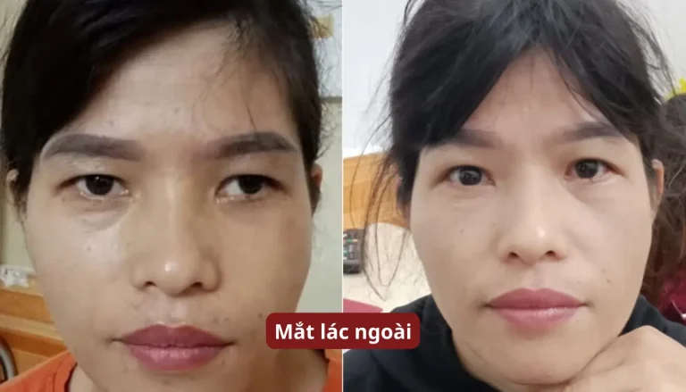 mắt lác ngoài sau chấn thương tai nạn (tổn thương dây thần kinh số III)