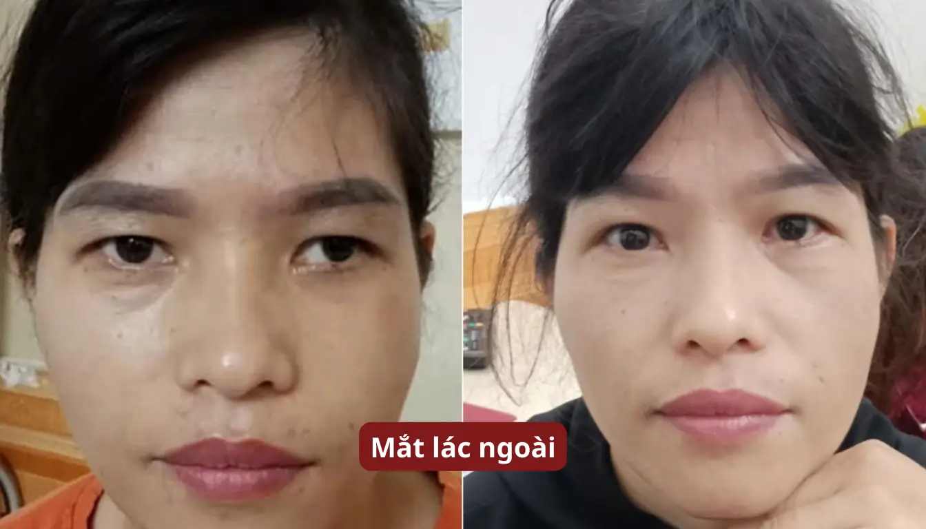 mắt lác ngoài sau chấn thương tai nạn (tổn thương dây thần kinh số III)