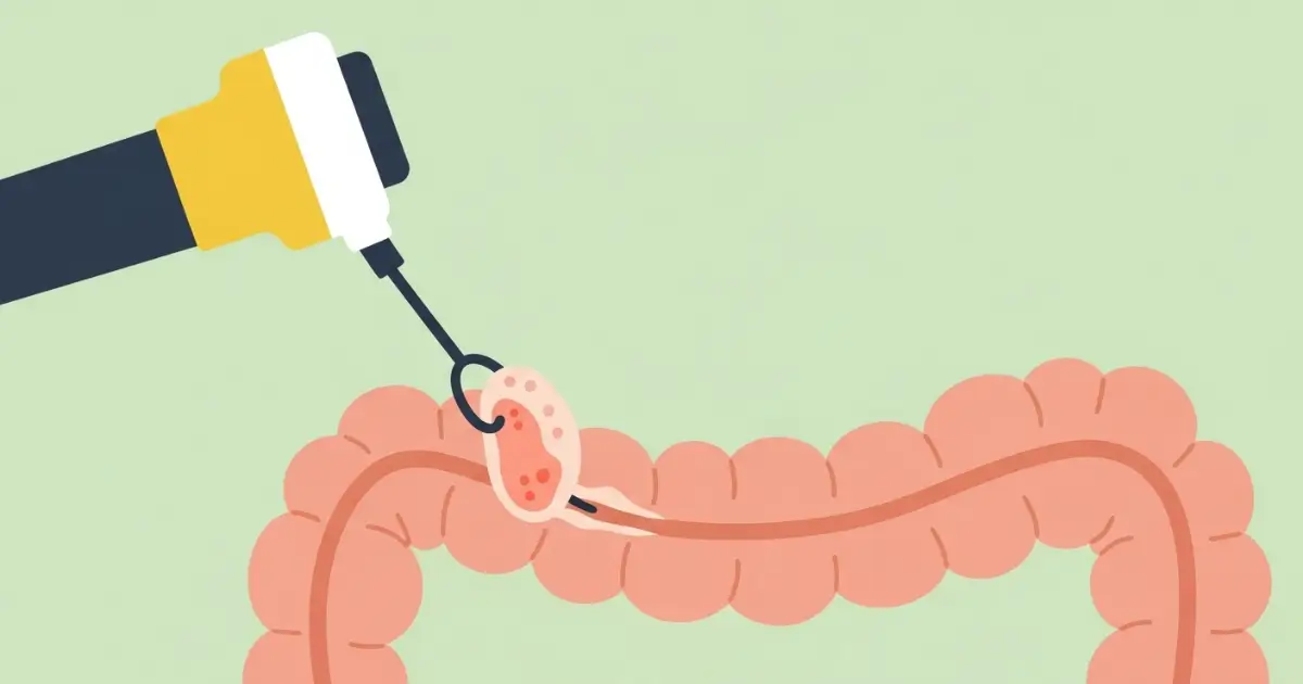 Cắt Polyp Đại tràng