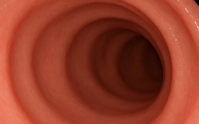 polyp-dai-trang-sau-dieu-tri-01