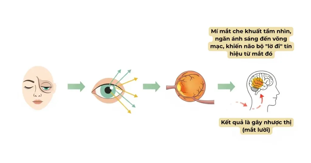Sơ đồ giải thích cơ chế sụp mí mắt bẩm sinh gây nhược thị (mắt lười).