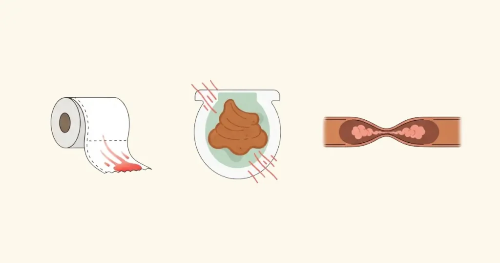 Các triệu chứng polyp đại tràng liên quan đến phân và chảy máu.