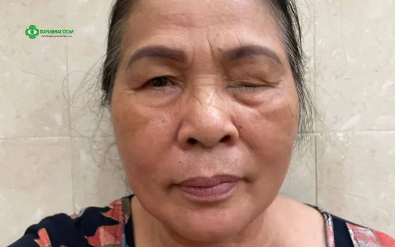 Liệt dây thần kinh số 3 do biến chứng bệnh tiểu đường