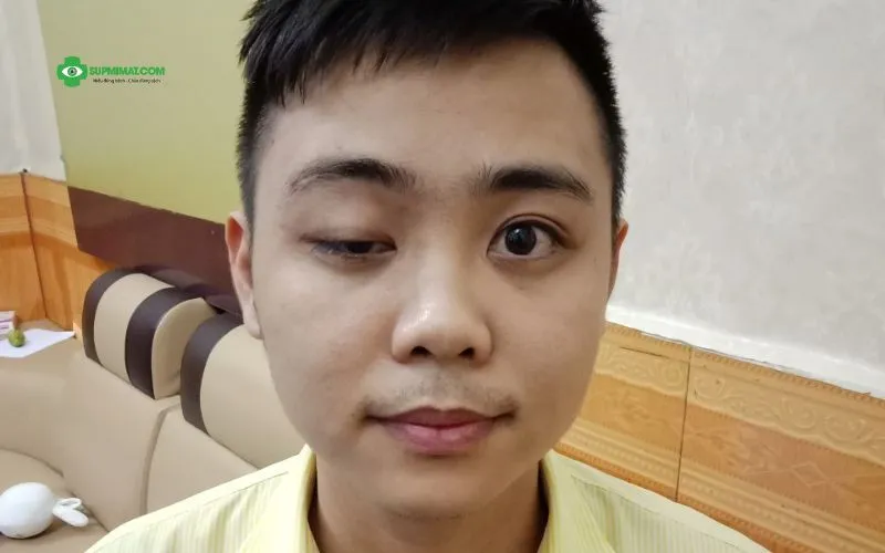 Sụp Mí Mắt Sau Chấn Thương