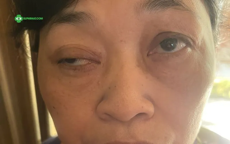 Sụp Mí Mắt Do Liệt Dây Thần Kinh Số 3