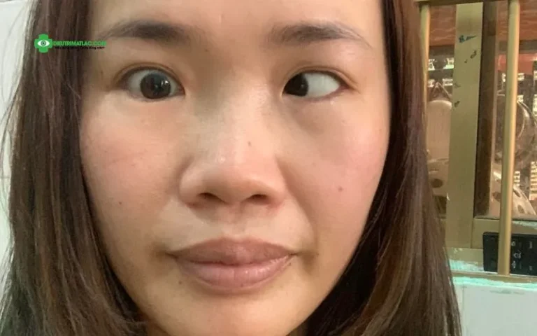 Mắt lác vào trong