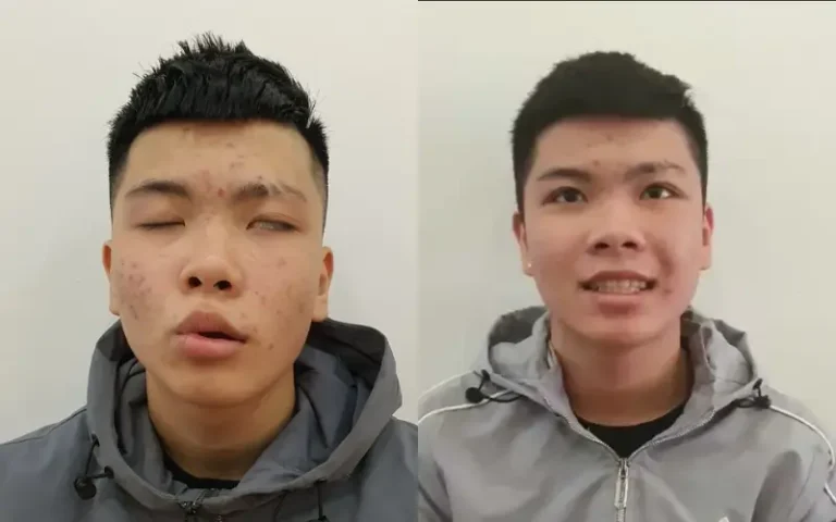 Đông Y Sơn Hà Điều Trị Liệt 7: "Trả Lại Nụ Cười Nguyên Bản" Bằng Phác Đồ Tam Ám Độc Quyền