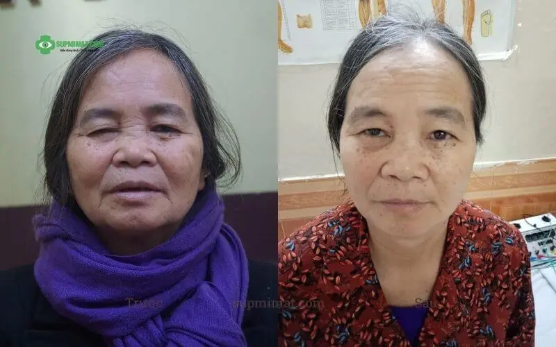 Sụp Mí Mắt Do Tai Biến ở người lớn tuổi