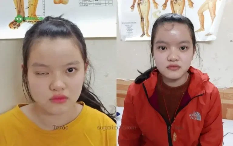 Điều trị sụp mí mắt bằng Đông y