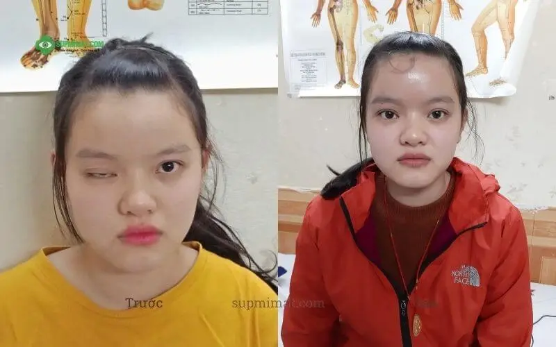 Điều trị sụp mí mắt bằng Đông y