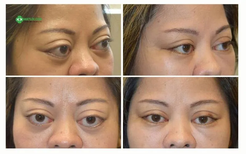 Đông y Sơn Hà Chữa Mắt Lồi Do Cường Giáp (Basedow) Bằng Y Học Cổ Truyền như thế nào? hinh-anh-truoc-sau-dieu-tri-mat-loi-2