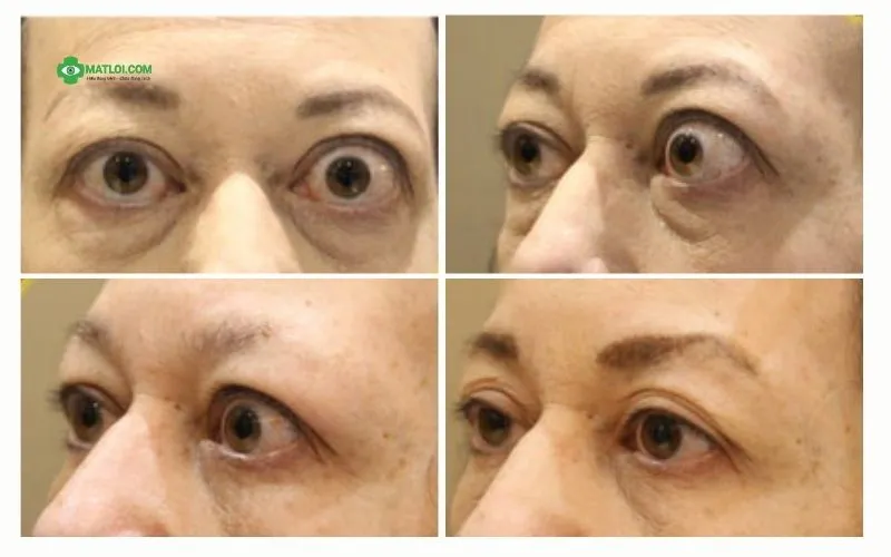 Đông y Sơn Hà Chữa Mắt Lồi Do Cường Giáp (Basedow) Bằng Y Học Cổ Truyền như thế nào? hinh-anh-truoc-sau-dieu-tri-mat-loi-3