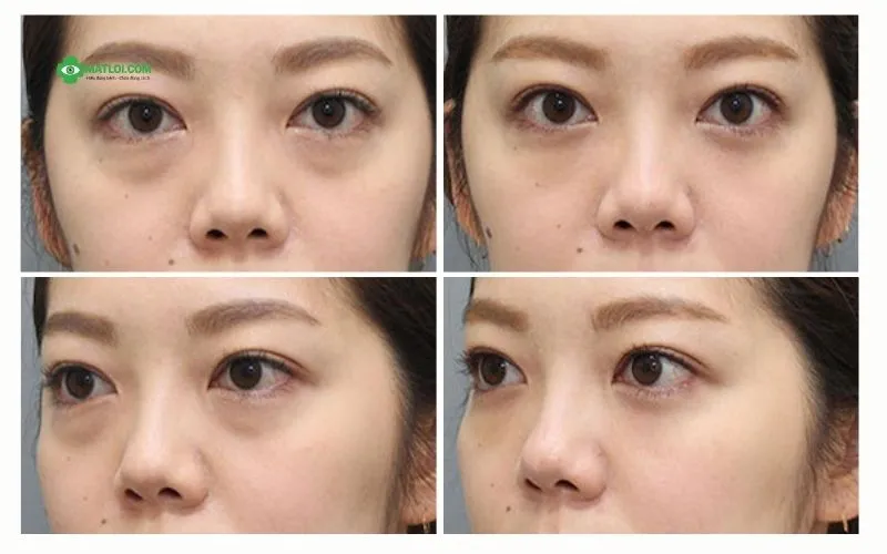 Đông y Sơn Hà Chữa Mắt Lồi Do Cường Giáp (Basedow) Bằng Y Học Cổ Truyền như thế nào? hinh-anh-truoc-sau-dieu-tri-mat-loi-4