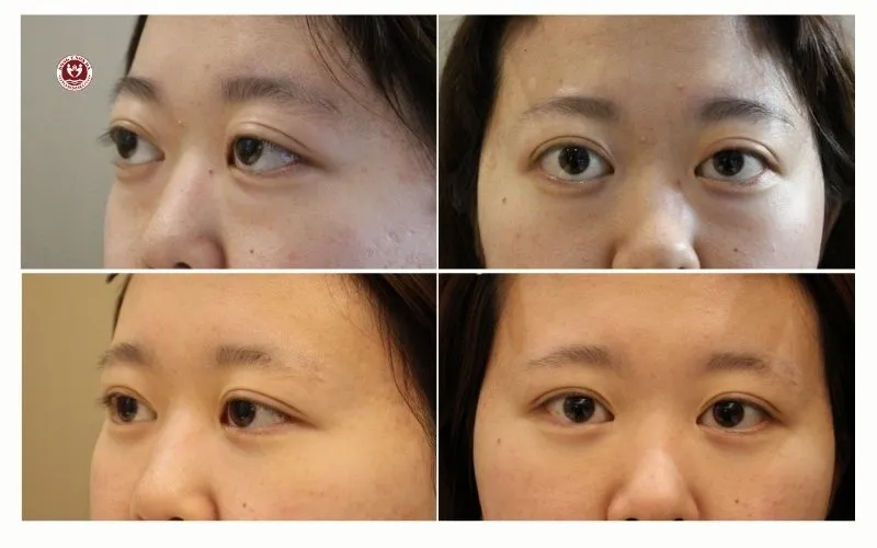 Đông y Sơn Hà Chữa Mắt Lồi Do Cường Giáp (Basedow) Bằng Y Học Cổ Truyền như thế nào? hinh-anh-truoc-sau-dieu-tri-mat-loi